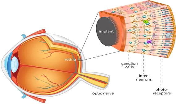 شبکیه مصنوعی هوشمند چشم هم تولید شد
