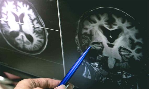 درمان آسیب‌های مغزی با پژوهش جدید محققان آمریکایی