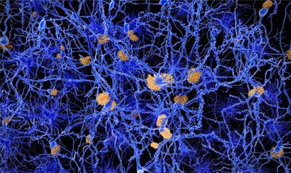 نشانه اولیه آلزایمر در مغز کشف شد