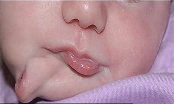 4گوشه دنیا/ نوزادی با دو دهان متولد شد!