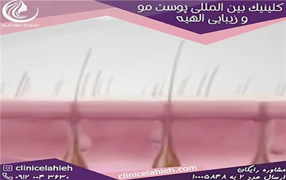 مراقبت های قبل و بعد لیزر موهای زائد چیست؟