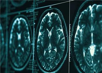 روشی در توقف بیماری آلزایمر کشف شد