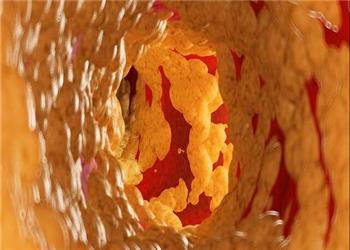 کاهش 58 درصدی کلسترول بد با یک داروی جدید