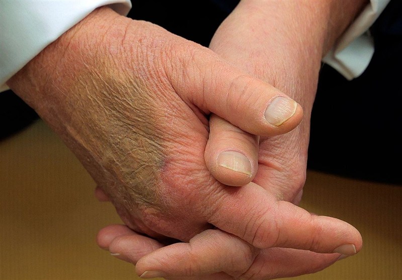 ترامپ در تلاش برای پنهان کردن کبودی مزمن دست راست