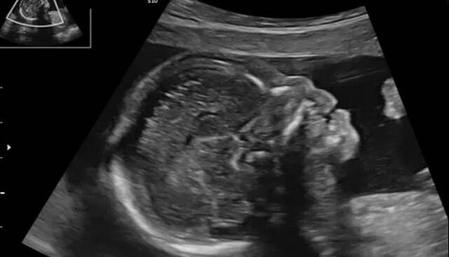 آیا تشخیص زودهنگام «سندرم داون» با شاخص استخوان بینی ممکن است؟