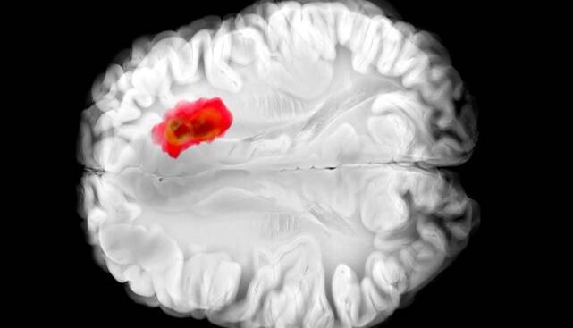 کشف دارویی برای مبارزه با کشنده‌ترین سرطان‌های مغز