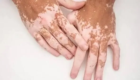 قرصی که رنگ پوست افراد مبتلا به پیسی را برمی‌گرداند
